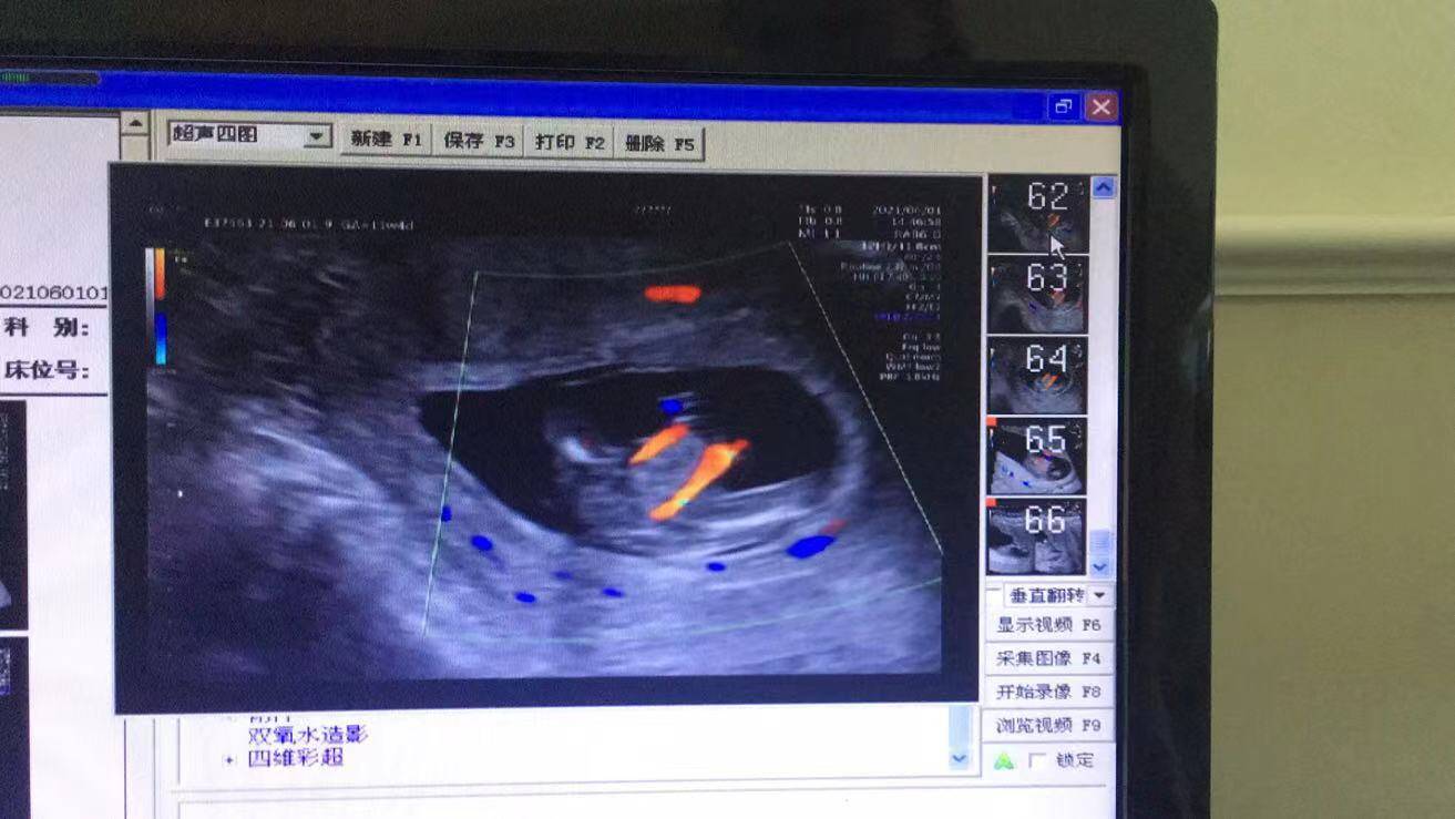 NT篩查出胎兒多發(fā)畸形，準媽媽無奈終止妊娠